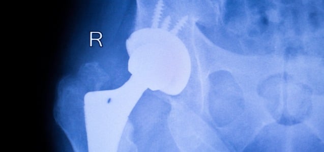 Strkyer LFit V40, Stryker Hip Replacement, Stryker Hip Recall, Personal Injury Law Firm Baltimore, Personal Injury Attorneys Maryland, Hip Replacement Law Firm Baltimore, Hip Replacement Lawyers Maryland, Defective Medical Device Attorney Baltimore, Defective Medical Device Law Firm Maryland, medical malpractice attorney baltimore