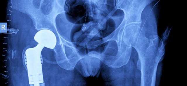 Defective Hip