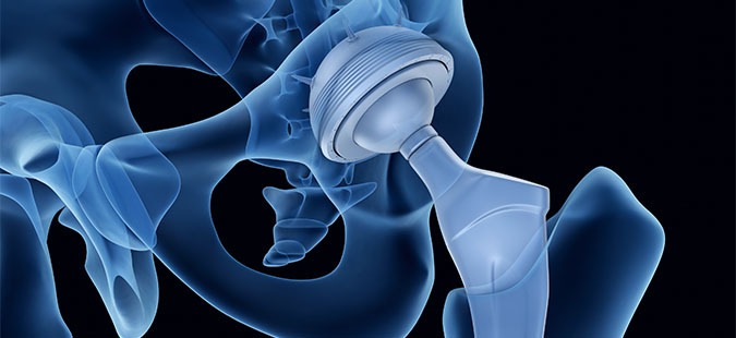 x-ray-of-hip-and-hip-implant