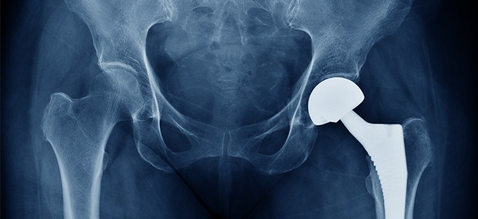 hip-implant-liner-x-ray