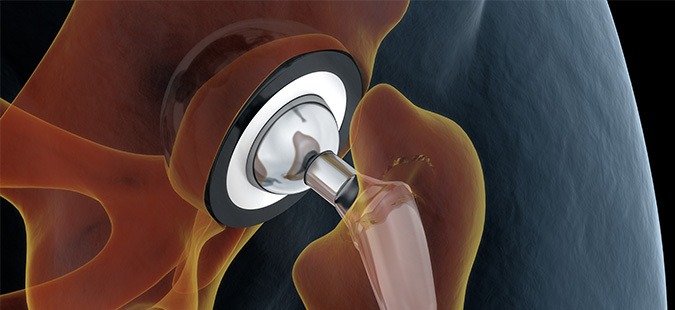 Exactech Hip Replacement