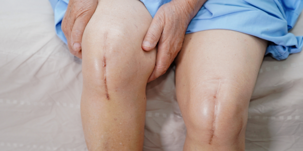 Total knee replacement surgery