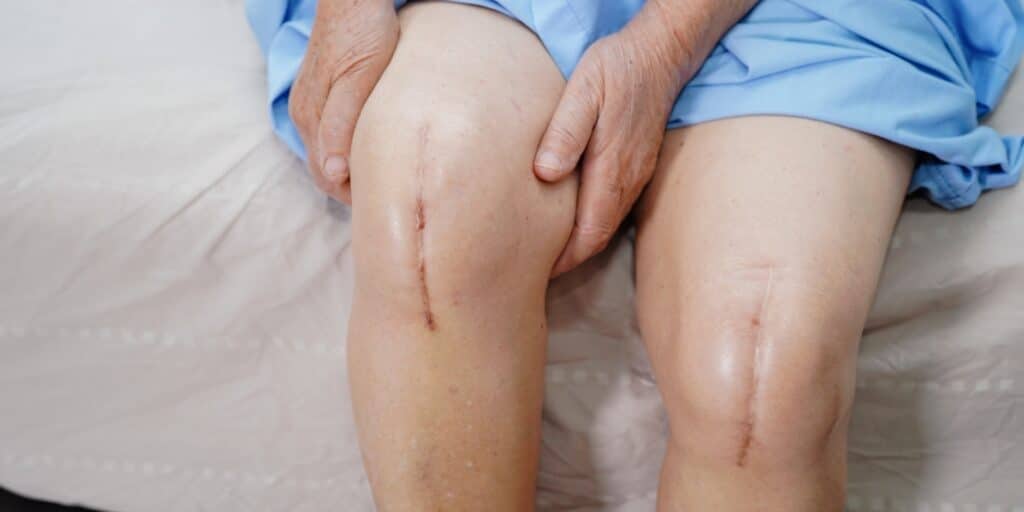 knee replacement recall lawsuit by The Yost Legal Group