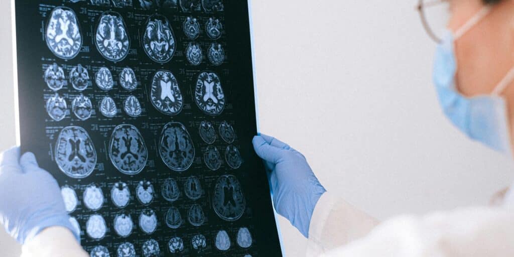 Choosing the Right Legal Advocate After a TBI Accident